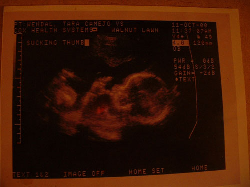 Ultrasound from Ella at 21 weeks and 5 days